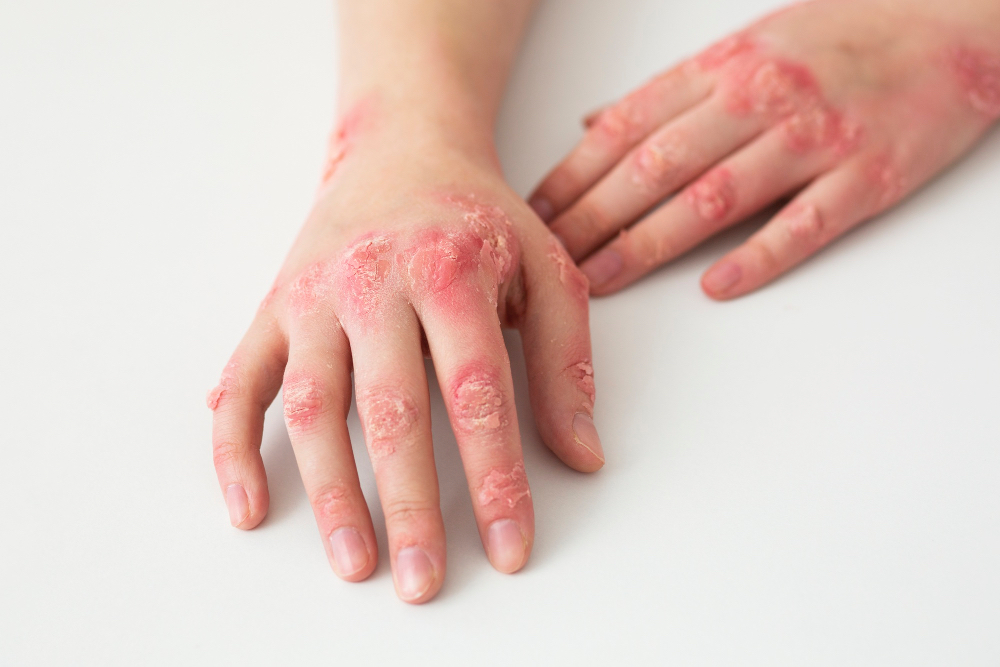 Kenali Impetigo pada Anak, Penyebab, Gejala, Pengobatan, dan Pencegahannya